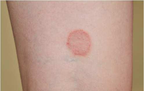 response to irritating substance Eczema noncontagious, inflammatory reaction irritant Impetigo highly contagious skin infection