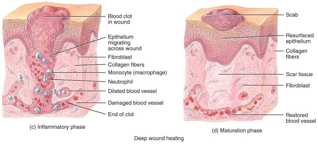 Wound Healing Two kinds of wound-healing processes can occur, depending on the depth of the injury.