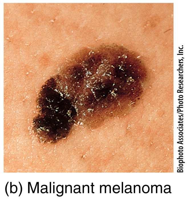 The three major types are basal cell carcinoma, squamous cell carcinoma and malignant