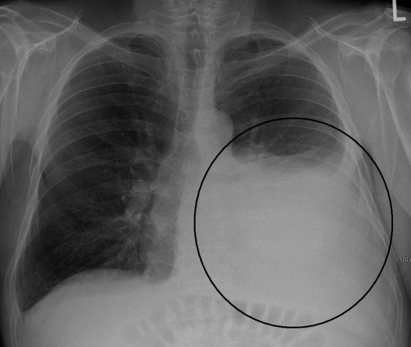 chest cavity Peritonitis