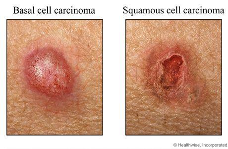 CANCERS OF THE SKIN Basal Cell