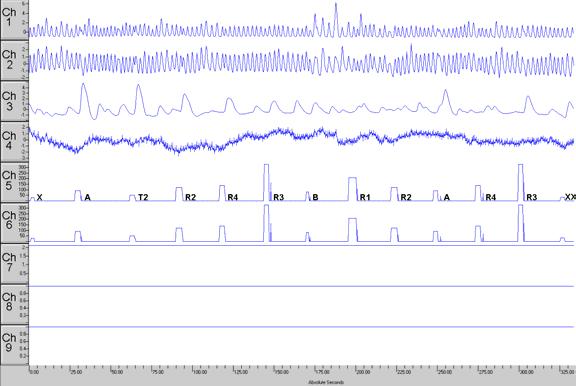 FIGURE 1 A. Truthful B. Deceptive Figure 1. Raw Waves from Single Subjects: Depicts the raw PDD waves as displayed in TFStudio.