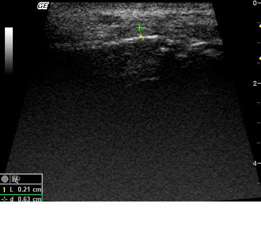 At the end of 2 months (Fig-5) no significant ultrasonographic feature were noted.