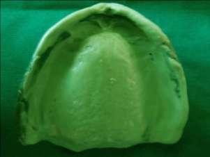 areas often results in a greater prosthodontic challenge.