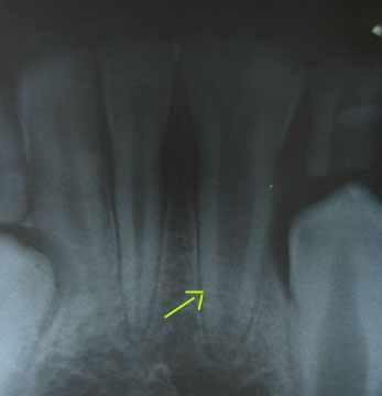 Case-1 A 8-year old boy reported to the department with the complaint of decay in the lower right first molar. Medical history was non contributory.