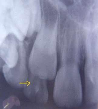 Case-2 A 9-year old boy reported to the department with the complaint of decay in the lower left first molar. Medical history was non contributory.