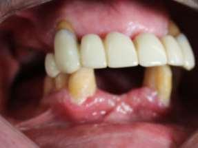 Hence it was planned to provide an interim immediate complete dentures using sectional tray. Primary Impression 1.