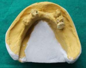 tray- maxillary Fig.