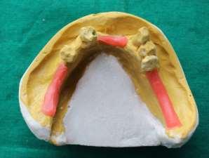 sectional tray- mandibular Fig.
