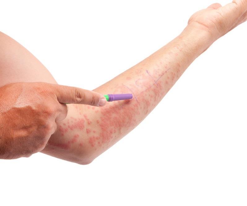 Allergic Contact Dermatitis Accounts for 10-15% of all occupational disease Most common adverse effect of topical drugs 25% of the European general population has a