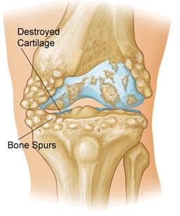 X-rays typically show a loss of joint space in the affected knee. Normal joint space between the femur and tibia. Decreased joint space due to damaged cartilage and bone spurs.