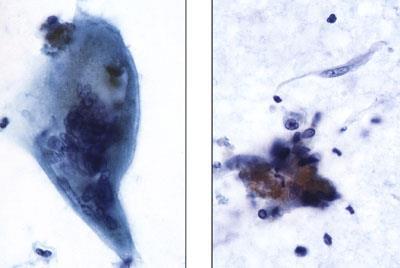 Rheumatoid Pleurisy Multinucleated giant cells Fibrinoid debris