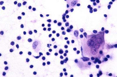 pleura: o Lymphocytosis - mostly T cells o Plasma cells o Rare