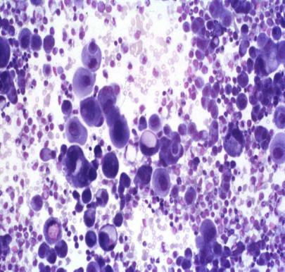 Reactive mesothelial cells (MGG) Other cells Histiocytes - ubiquitous (likely transformed mesos) Similar in size to mesothelials