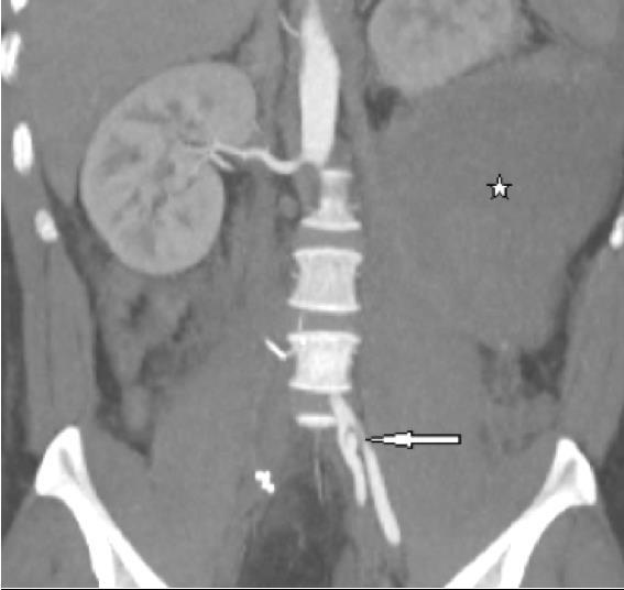 new vascular rupture after surgical excision and ligation of the ruptured right common iliac artery dissection.