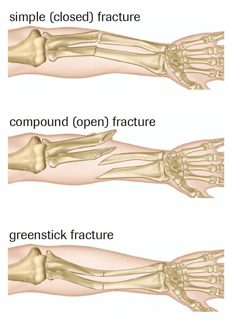 tendons bands of connective tissue that join muscle to bone bursae sacs of fluid found between tendon and bone Skeletal Injuries A bone fracture is a broken bone.
