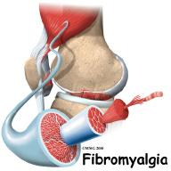 Introduction Fibromyalgia, a common painful disorder among women in their middle years (40 to 60 years old) is no longer considered a disease but rather a syndrome.