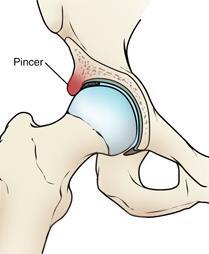FEMOROACETABULAR IMPINGEMENT pincer impingement This refers to a morphological or orientational abnormality of the acetabulum leading to an overcoverage of the femoral head.