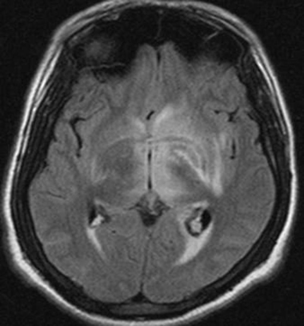 Fig. 24: Radiation necrosis of optic chiasma following radiotherapy for pituitary