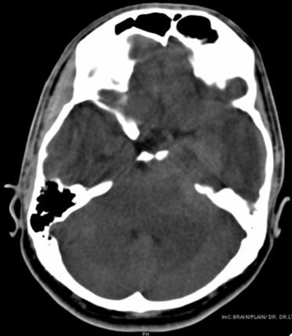 Fig. 28: Aspergillous granuloma.