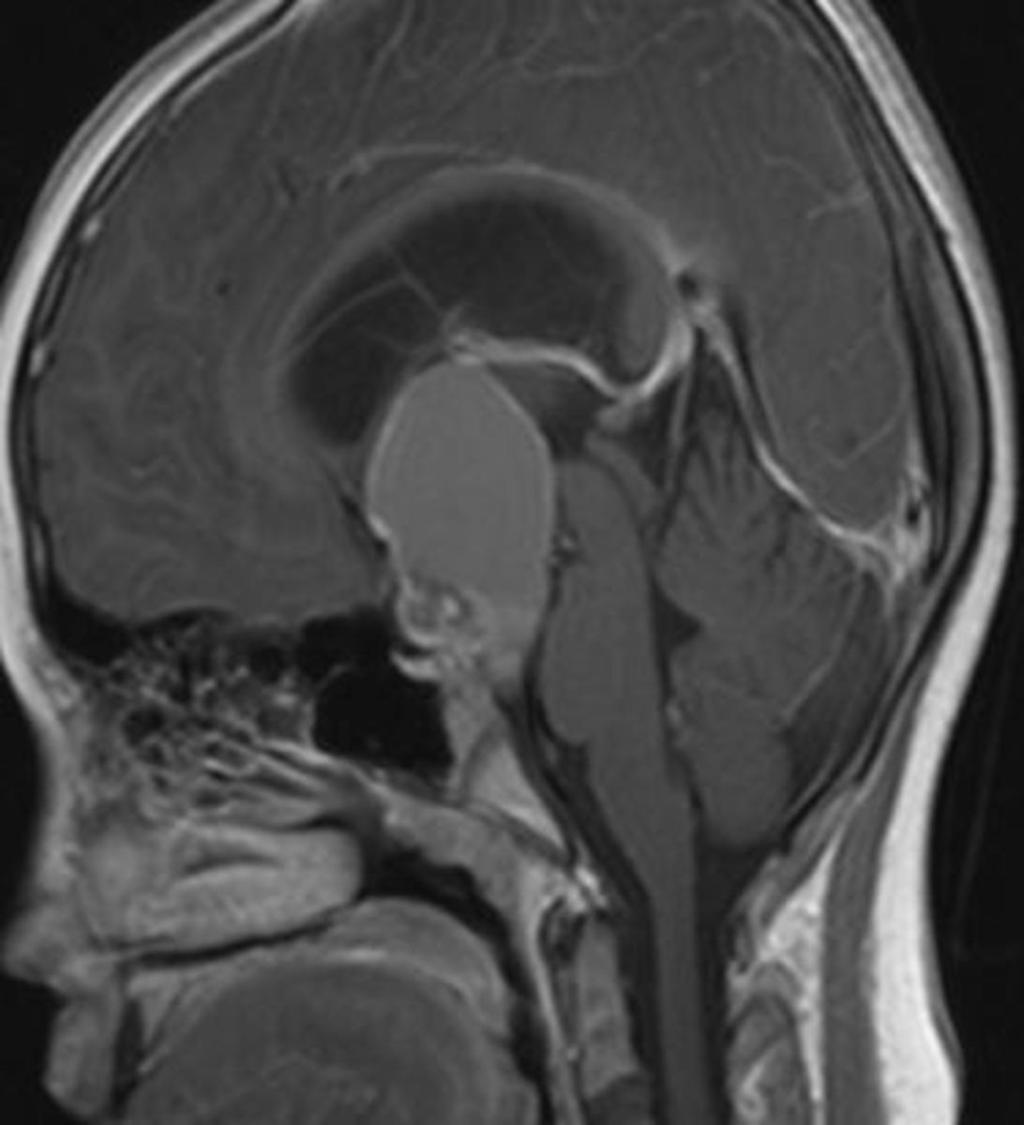 Fig. 32: Craniopharyngioma showing