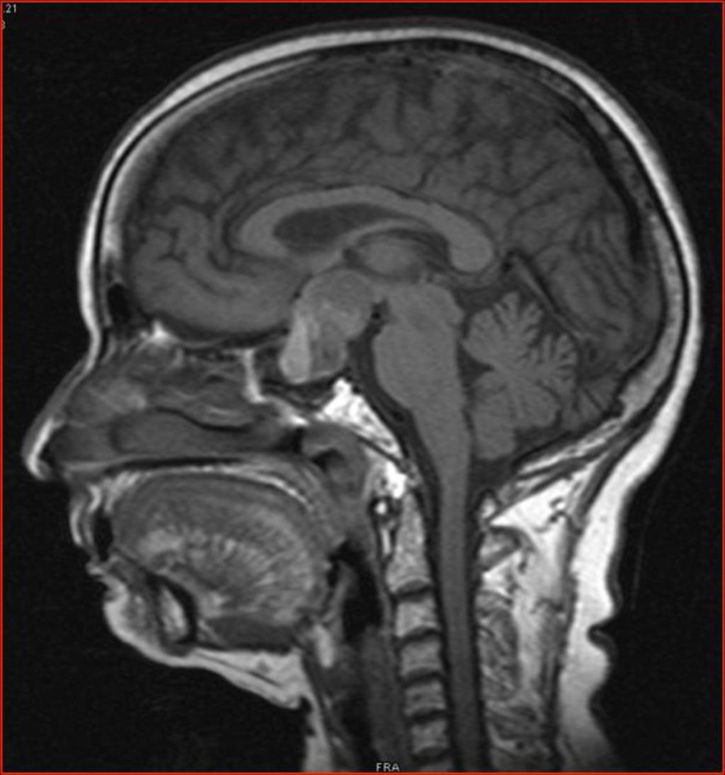 Fig. 33: Pituitary