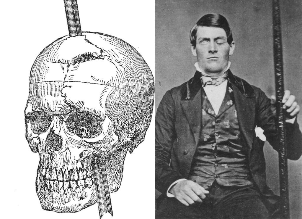Phineas Gage Neuroscience Most Famous Patient In 1848, Gage, 25, was the foreman of a crew cutting a railroad bed in Cavendish, Vermont.