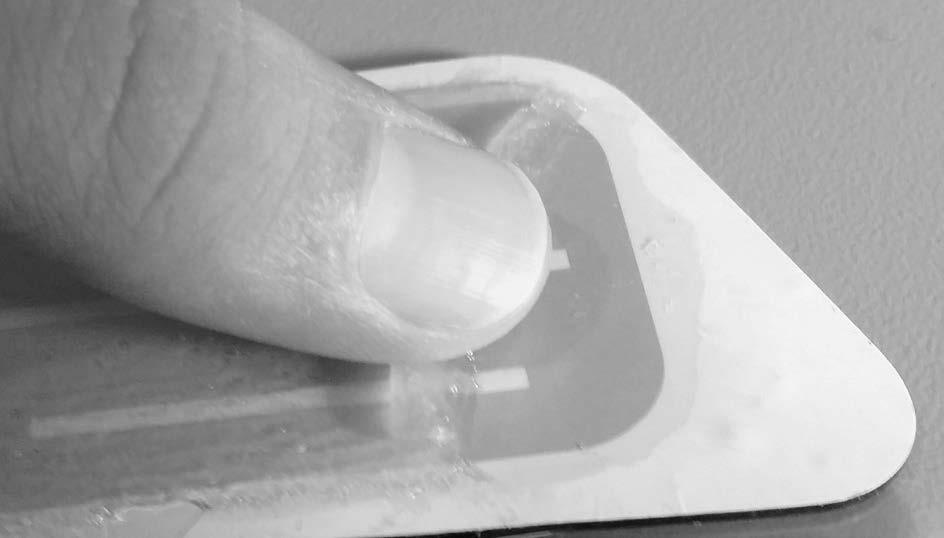 Figure 1 To remove gel pads from electrodes, gently roll the edge of the gel pad back with your thumb. When rolled back correctly, the gel pad will roll off in one single piece as seen in Figure 1.