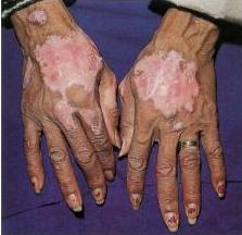 2. DISCOID LUPUS Coin and round-shaped erythematous plaques with adherent scale
