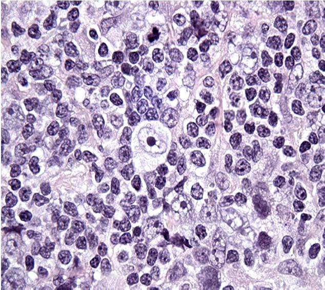 Relevance of the Immune Checkpoint in Classical HL Pathology of chl: rare malignant Reed Sternberg cells within an extensive inflammatory/immune cell infiltrate. Genetic analyses: frequent 9p24.
