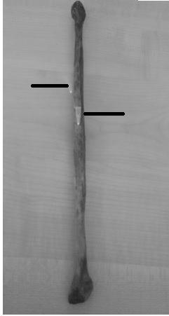 Nutrient in femur: All the observed in femur were directed upwards. 88.26% of the allowed the passage of 24 gauge needle and were considered as dominant. 11.