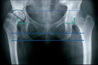 10 CLS Spotorno Hip Cup Surgical Technique Preparation of the Acetabulum and Determination of the Center of Rotation The