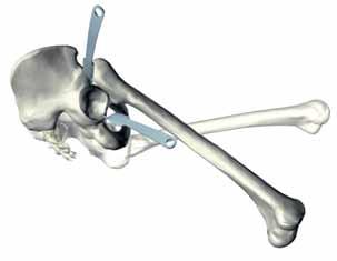 Starting from the medial mark, the upper edge of the neck of the femur is reached at the point where it rises from the mass of the trochanter.
