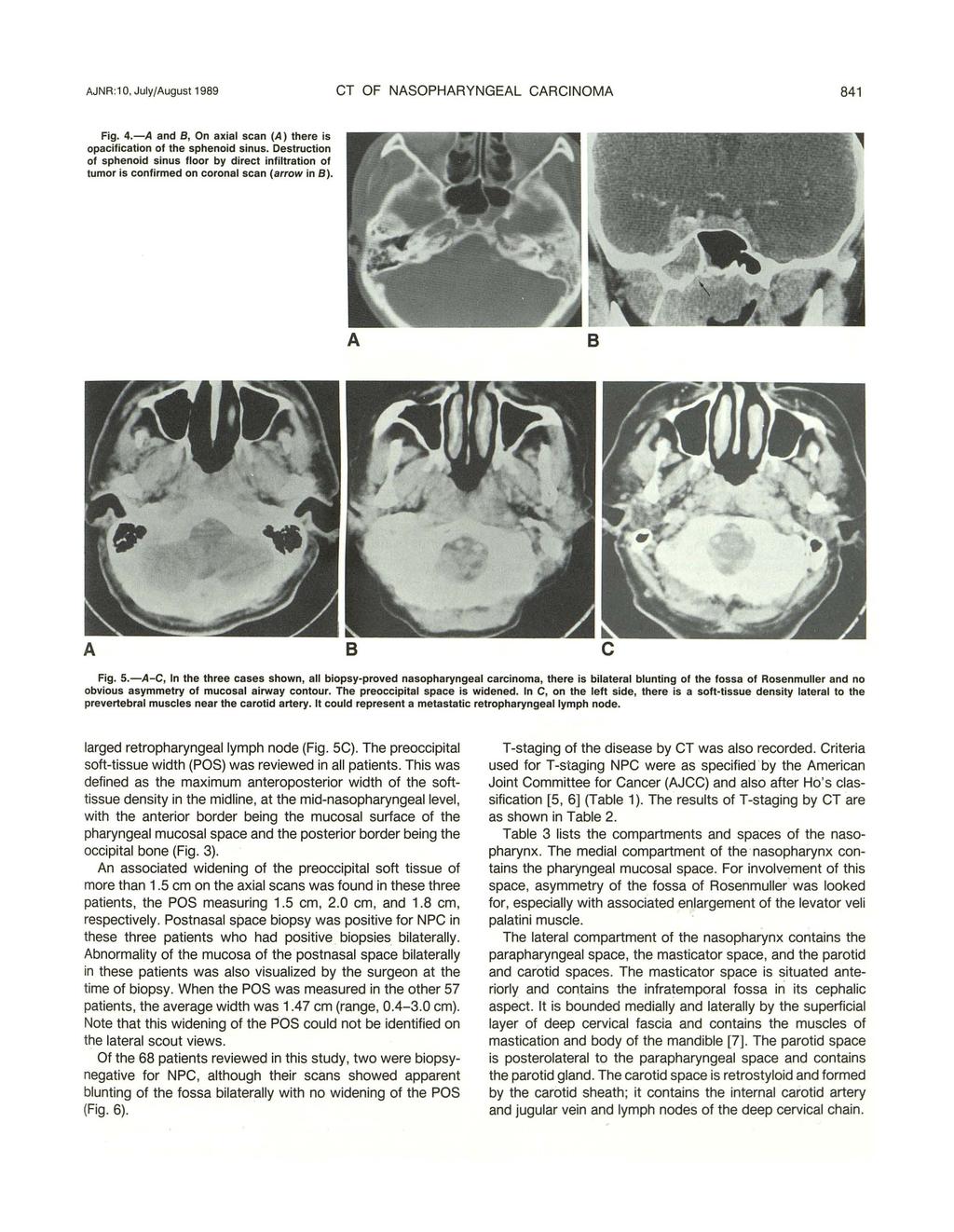 AJNR :1 0, July/August 1989 CT OF NASOPHARYNGEAL CARCINOMA 841 Fig. 4.-A and 8, On axial scan (A) there is opacification of the sphenoid sinus.