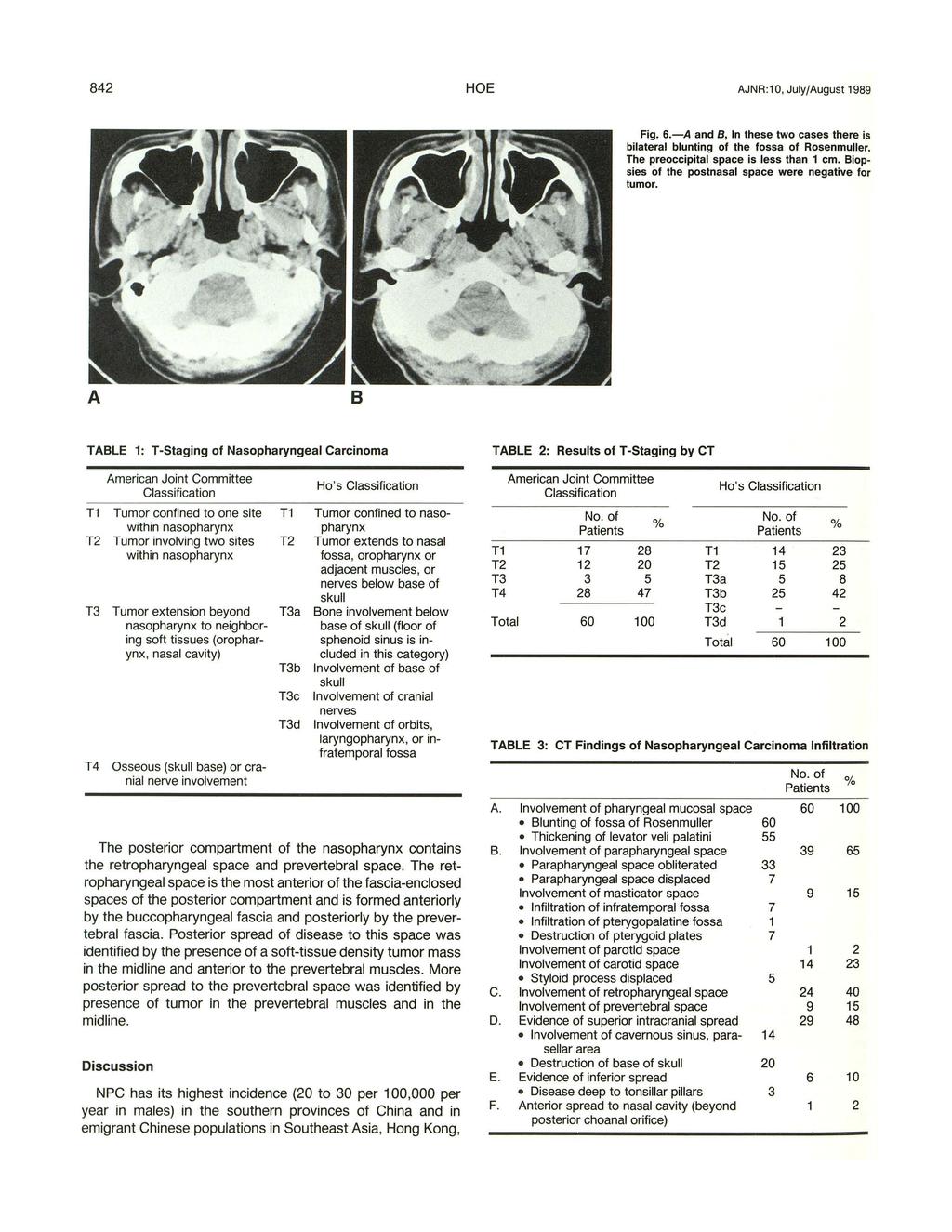 842 HOE AJNR:1 0, July{August 1989 Fig. 6.-A and B, In these two cases there is bilateral blunting of the fossa of Rosenmuller. The preoccipital space is less than 1 em.