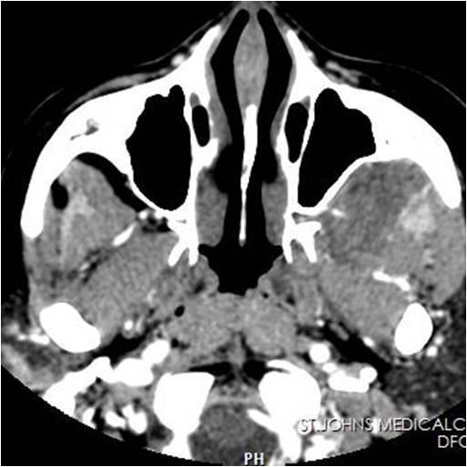 CT Skull base to the mediastinum was done. MRI brain was performed after the CT study to evaluate the intracranial component.