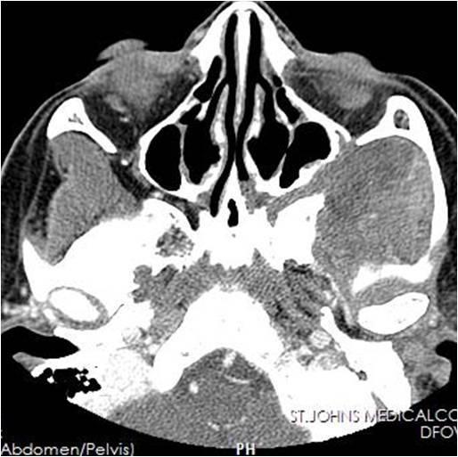 Biopsy from the infratemporal fossa mass were consistent with Meningioma (WHO Grade I).