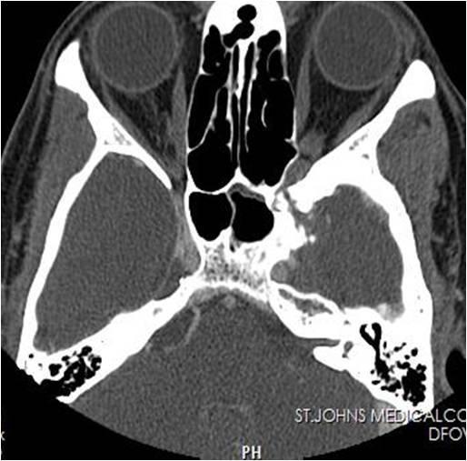 Fig 2C: Extension superiorly into the left middle cranial fossa via the Foramen rotundum Fig 1G CASE REPORT: 2 A 38-year-old lady