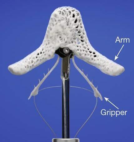 The MitraClip Device Implant made of cobalt chromium Polyester-covered to promote healing