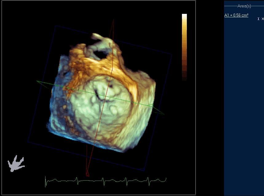 Mitral Stenosis Diagnosis Multiplanar reconstruction for stenosis assessment