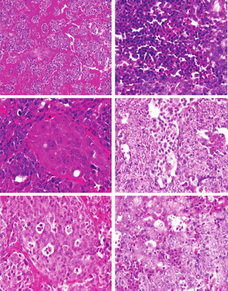Figure 1 H&E staining of neuroblastomas from MYCN transgeni mie. (A) Islands of undifferentiated neuroblastoma separated by fibrous septae (Neu 23) (6200).