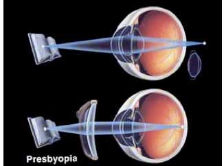 Presbyopia (old age vision) After age 40, the lens is less flexible Doesn