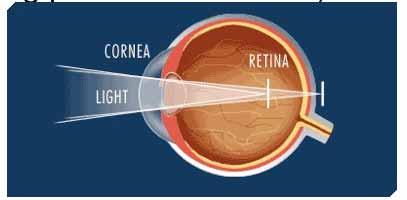Astigmatism Eye is not a sphere, so light rays get focused at two different points Patients note