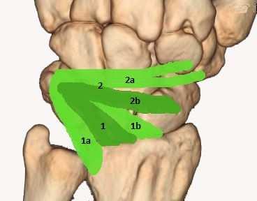 Dorzálny interkarpálny väz (lig. intercarpale dorsale) vyžaruje z dorzálnej plochy triquetra radiálnym smerom. Jeho hrubšia proximálna časť sa niekedy označuje ako lig. scaphotriquetrale dorsale (12).