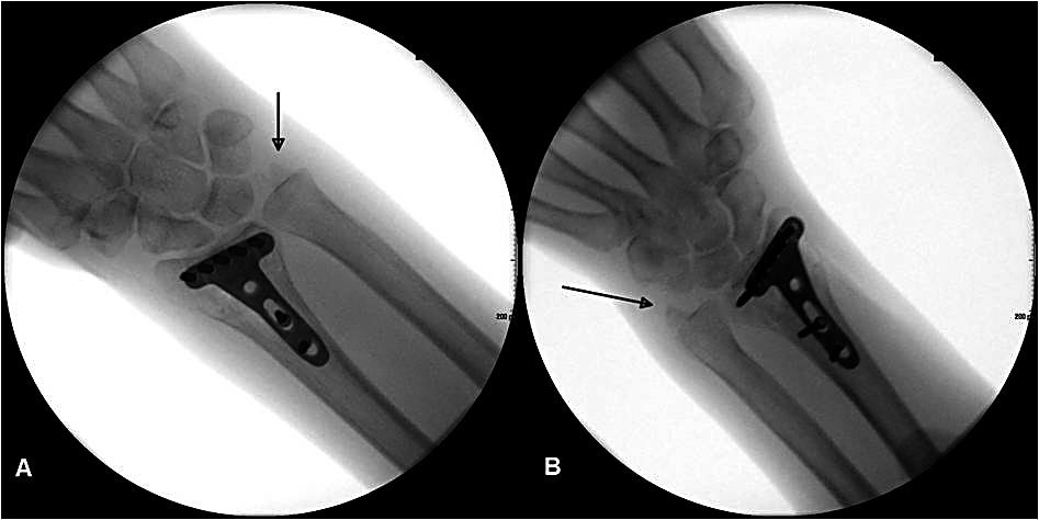 radiologyassistent.nl Obr. 22. RTG snímka zápästia v supinácii (A) a v pronácii (B). Šípka poukazuje na rozdielnu polohu processus styloideus ulny.