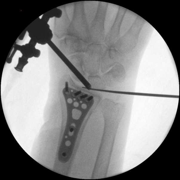 zvodovej anestézie v bezkrvnom prostredí turniketu a distrakcia kĺbu sa dosahuje trakčným zariadením vo vertikálnej alebo horizontálnej polohe (Obr. 29.).