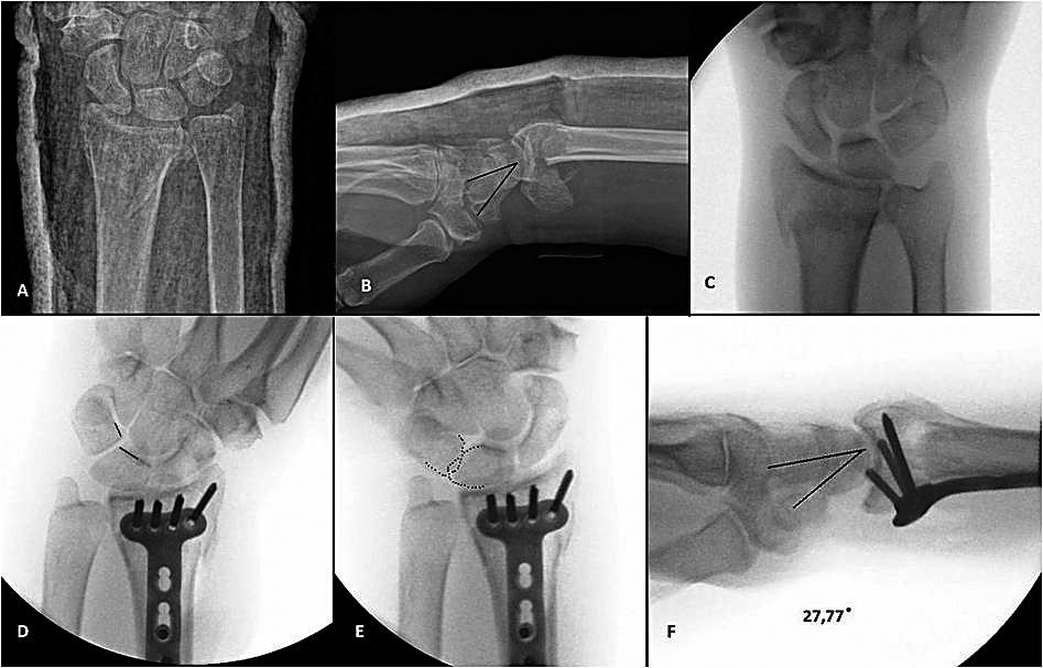 uvedená artroskopická klasifikácia poranení, založená na vyšetrení instability z RC ako aj MC kĺbu, platí aj pre poranenia tohto väzu.