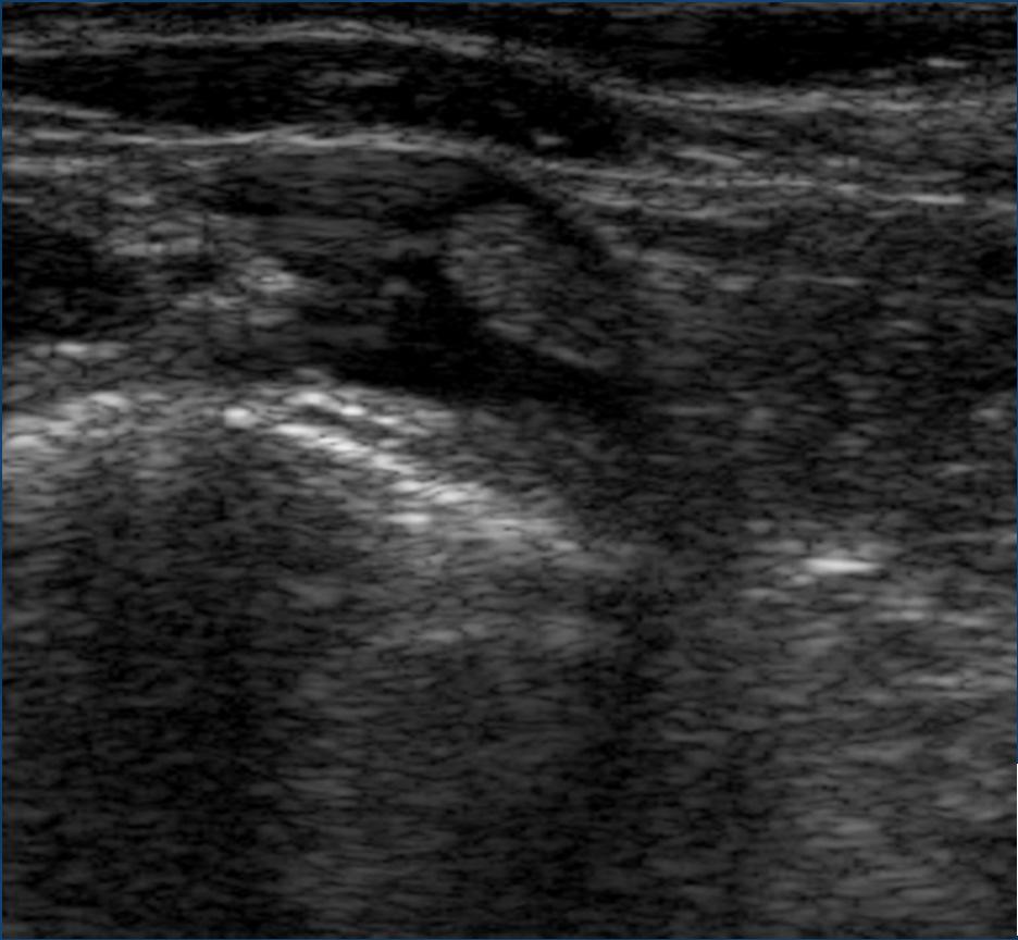 IJV patency assessed by US normal appearance