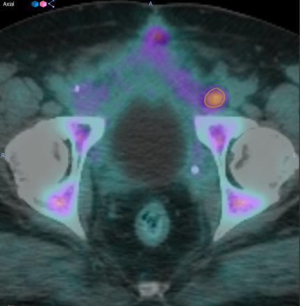 PET/CT in Prostate Cancer: Image-Guided Radiotherapy Planning F-18 fluciclovine imaging can be used