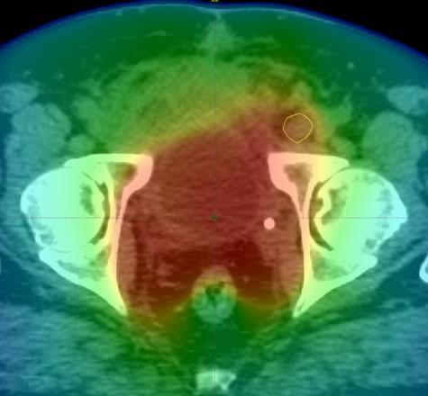 Fluciclovine imaging results reveal iliac lymph node involvement C.